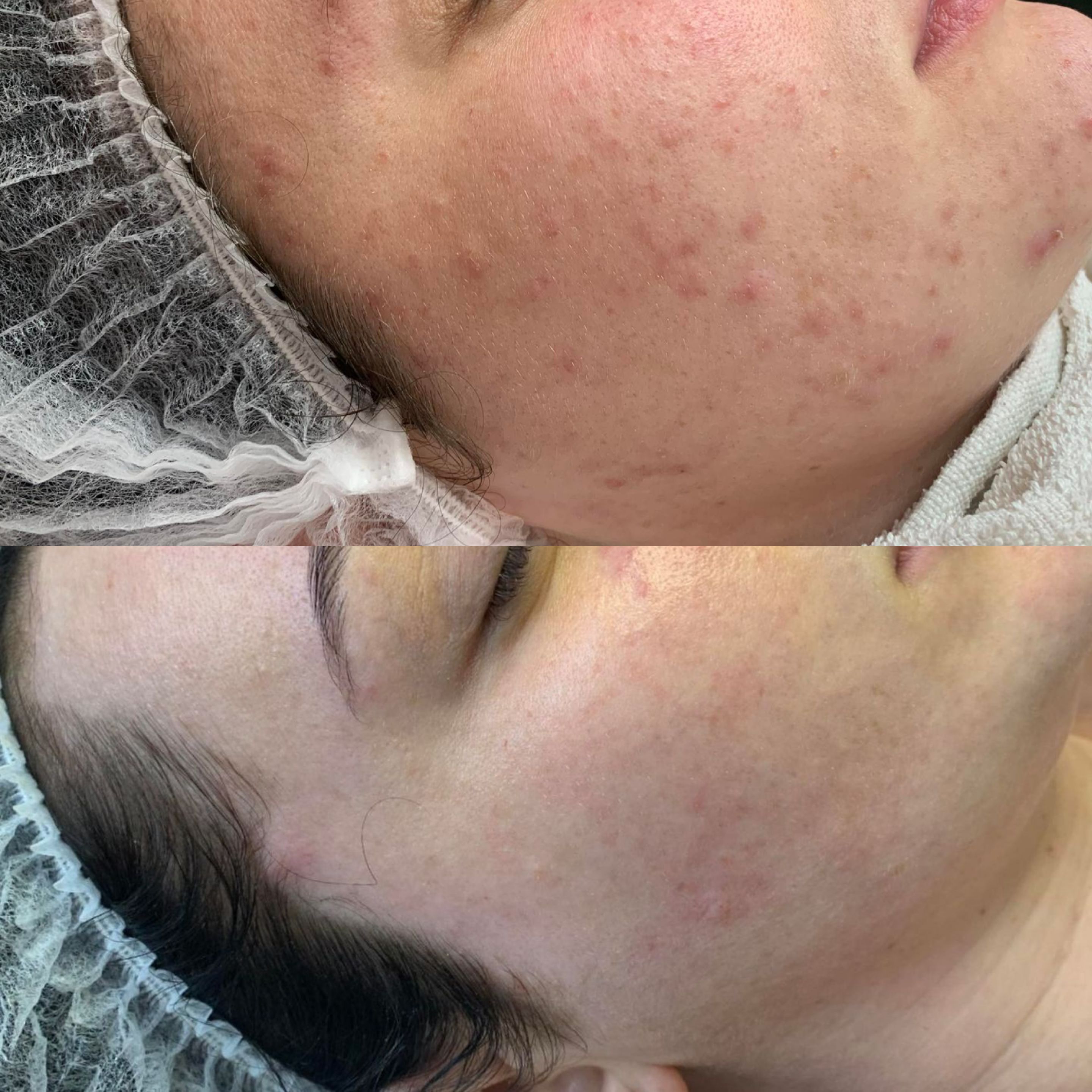 Efekt zabiegu kosmetologicznego - SkinLab Bydgoszcz