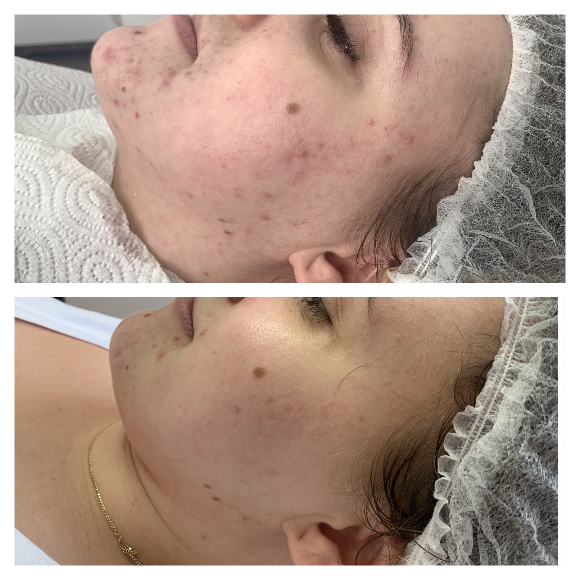 Efekt zabiegu kosmetologicznego - SkinLab Bydgoszcz