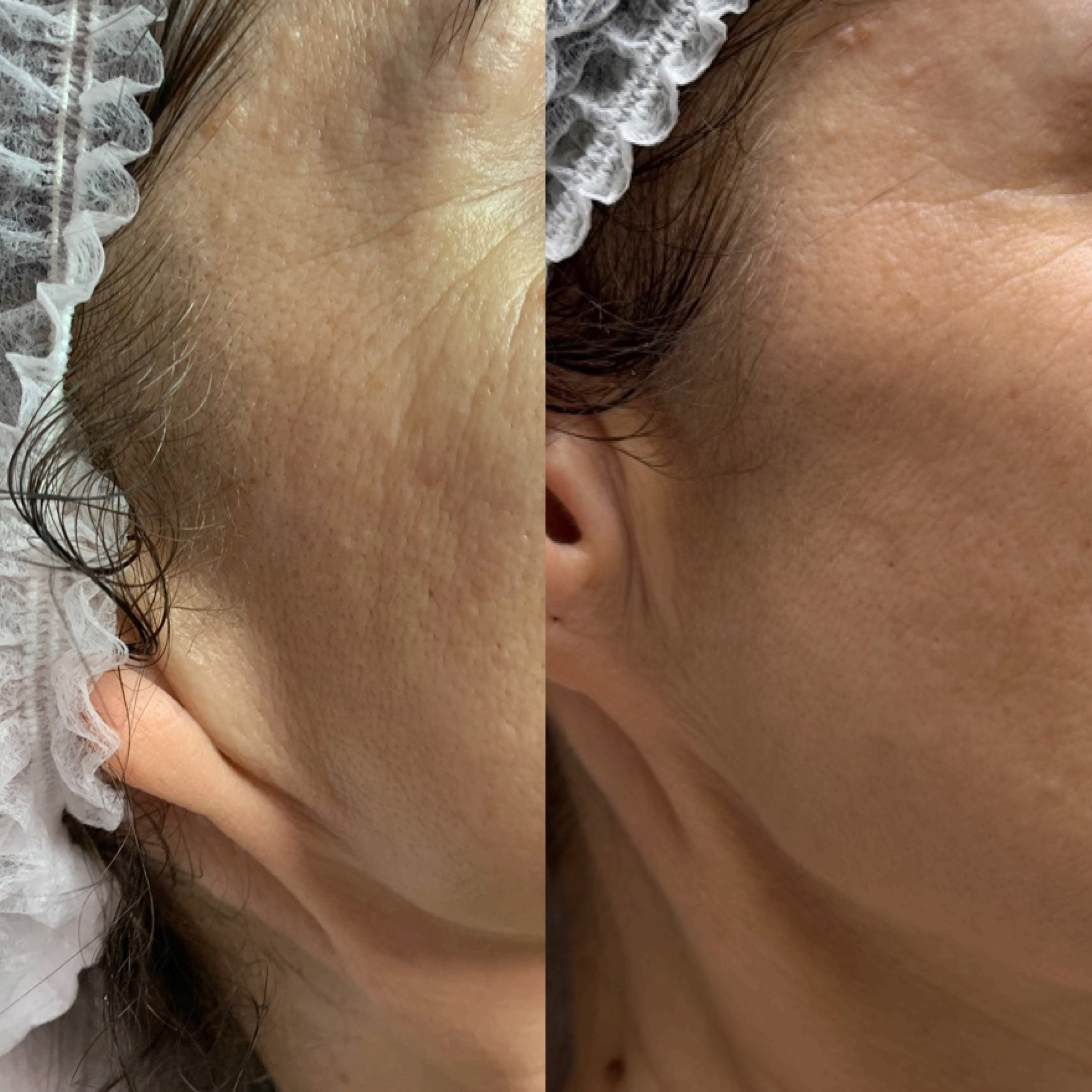 Efekt zabiegu kosmetologicznego - SkinLab Bydgoszcz