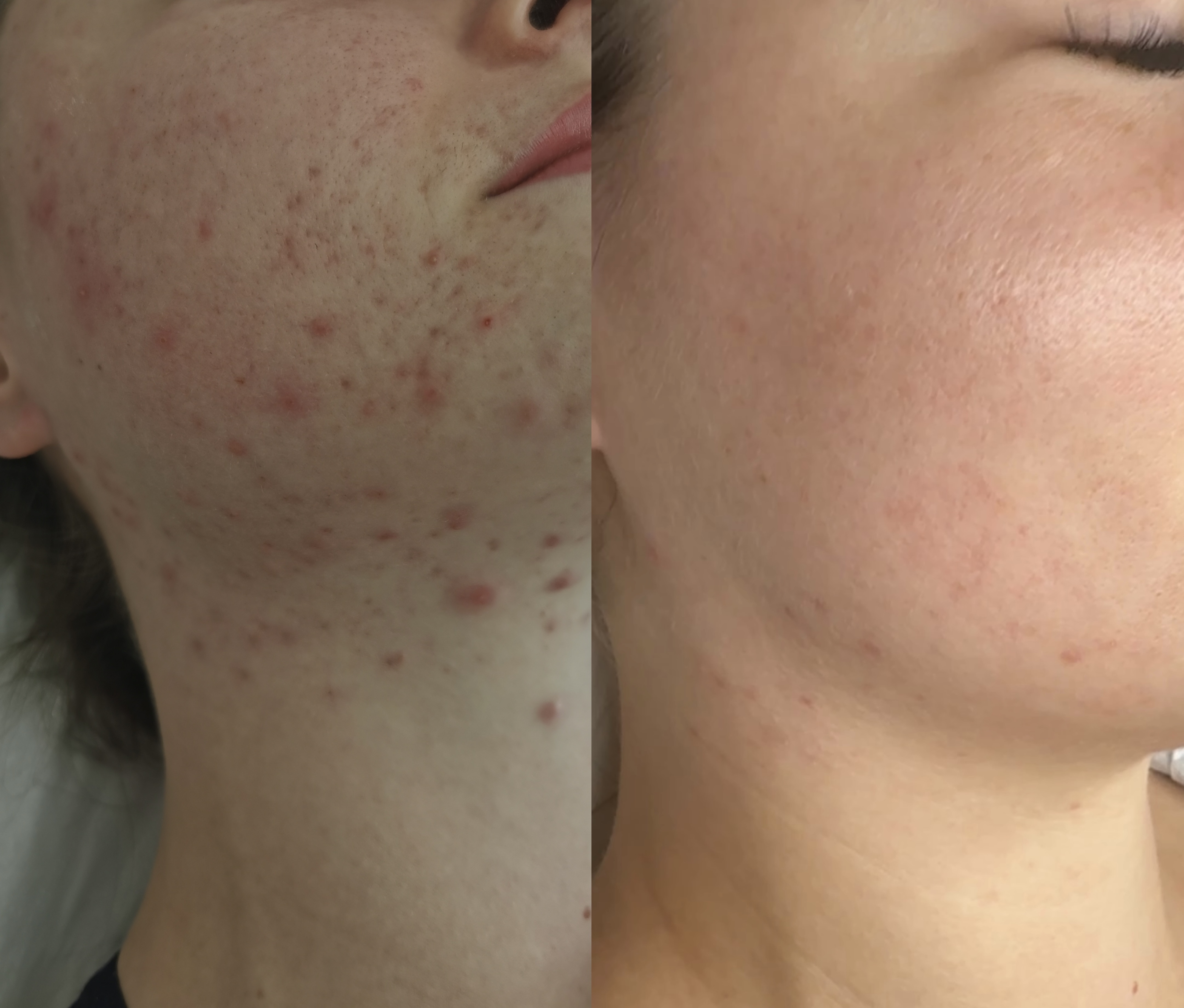 Efekt zabiegu kosmetologicznego - SkinLab Bydgoszcz