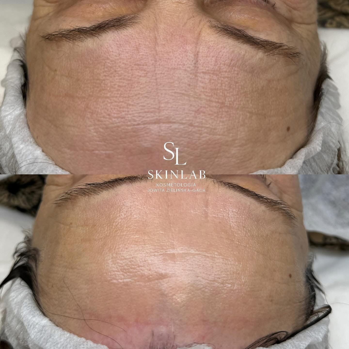 Efekt zabiegu kosmetologicznego - SkinLab Bydgoszcz