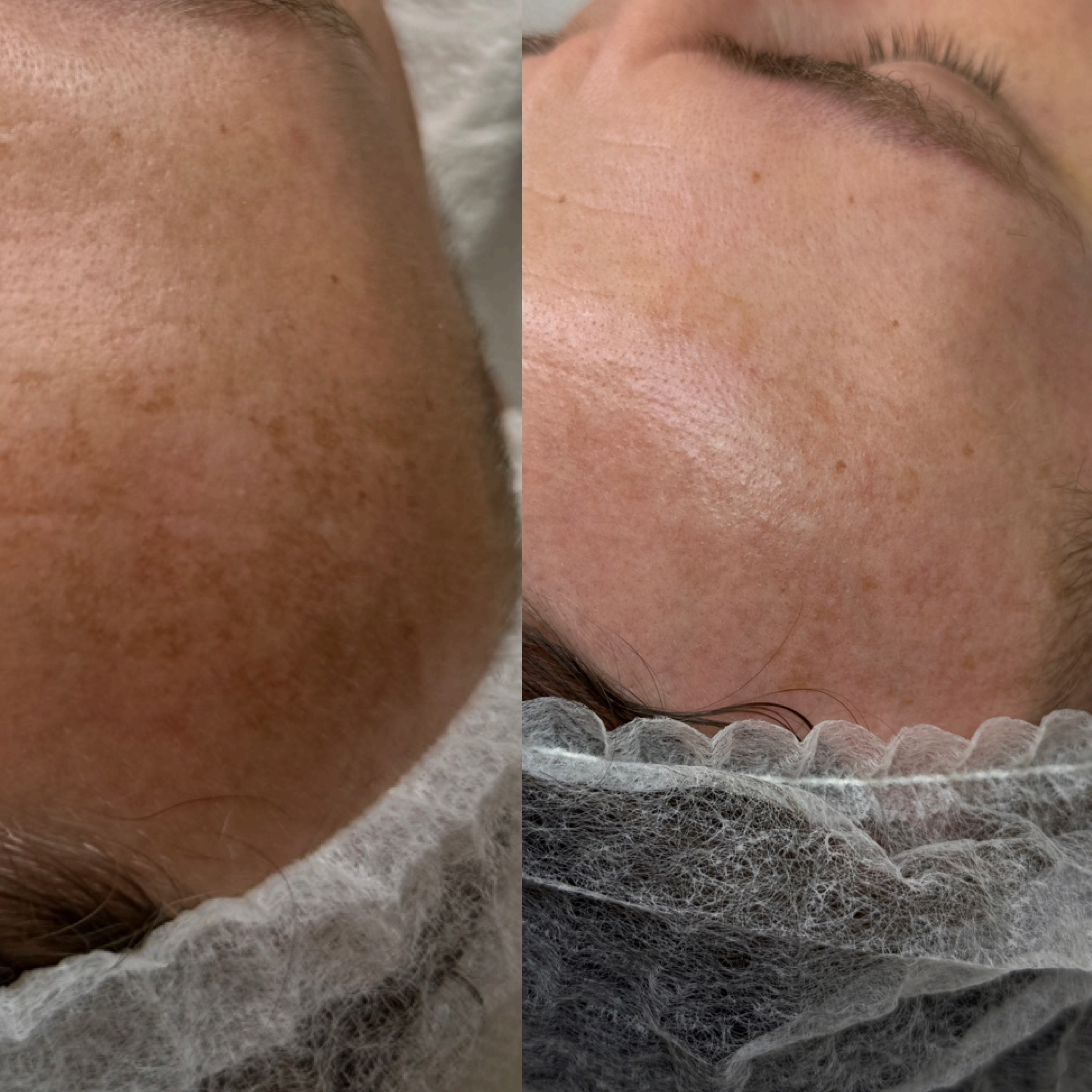 Efekt zabiegu kosmetologicznego - SkinLab Bydgoszcz