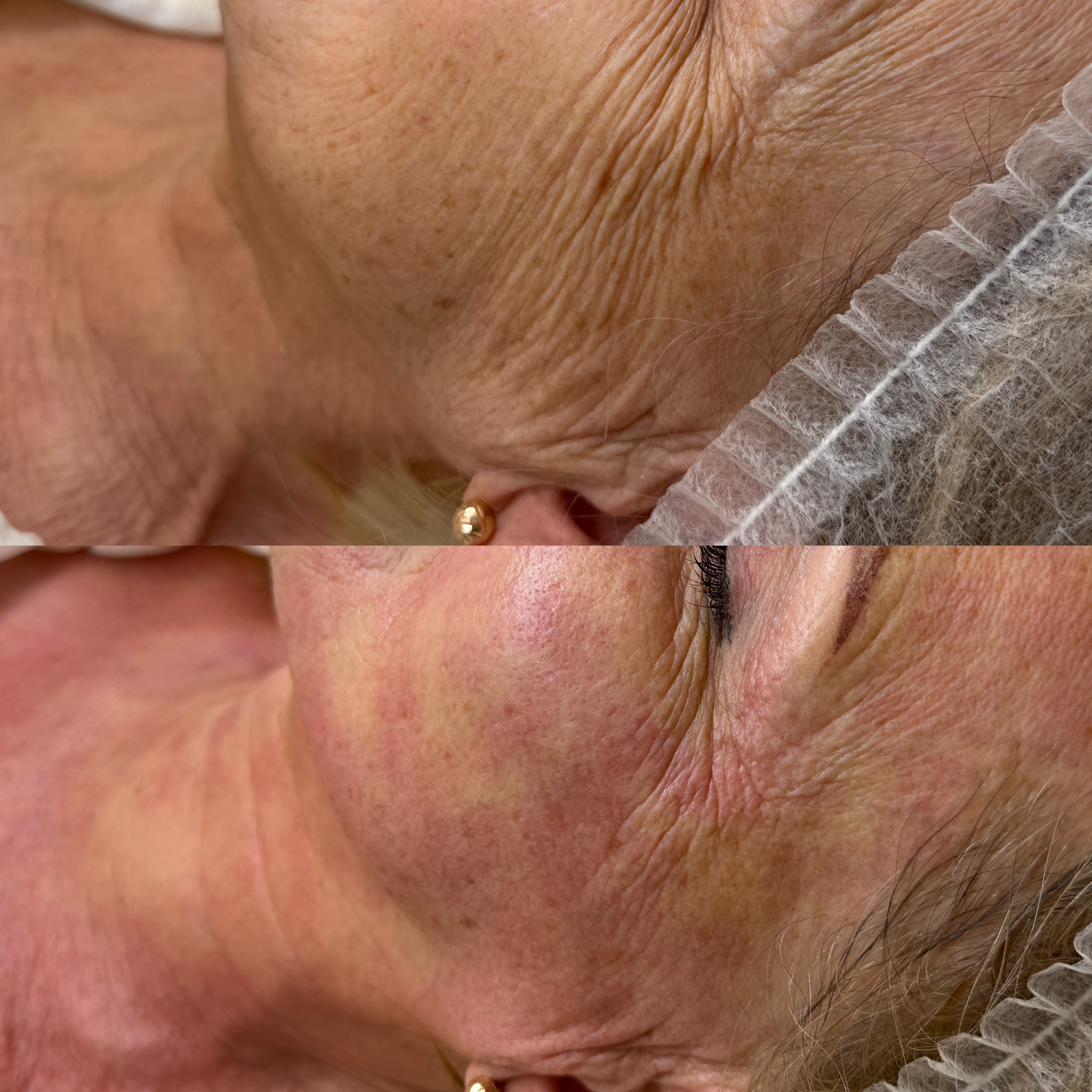 Efekt zabiegu kosmetologicznego - SkinLab Bydgoszcz